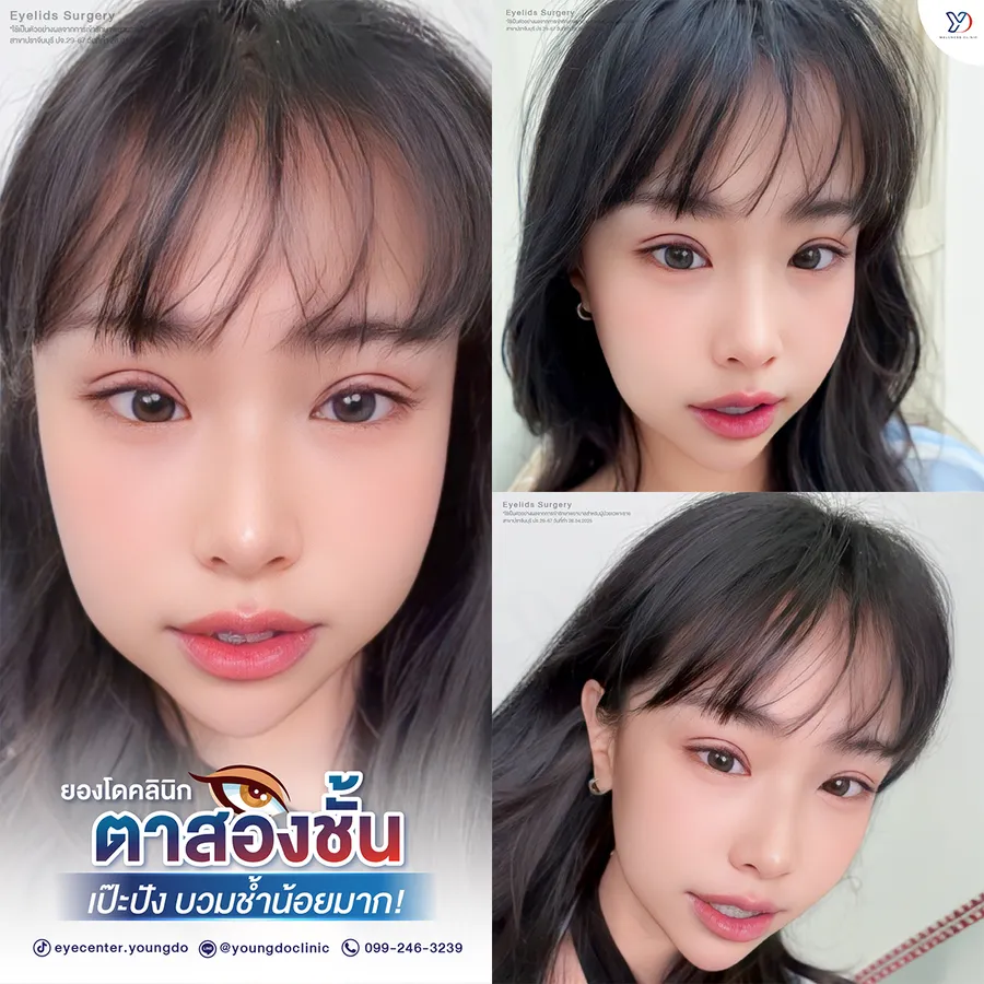 รีวิวตาสองชั้นยองโด-05