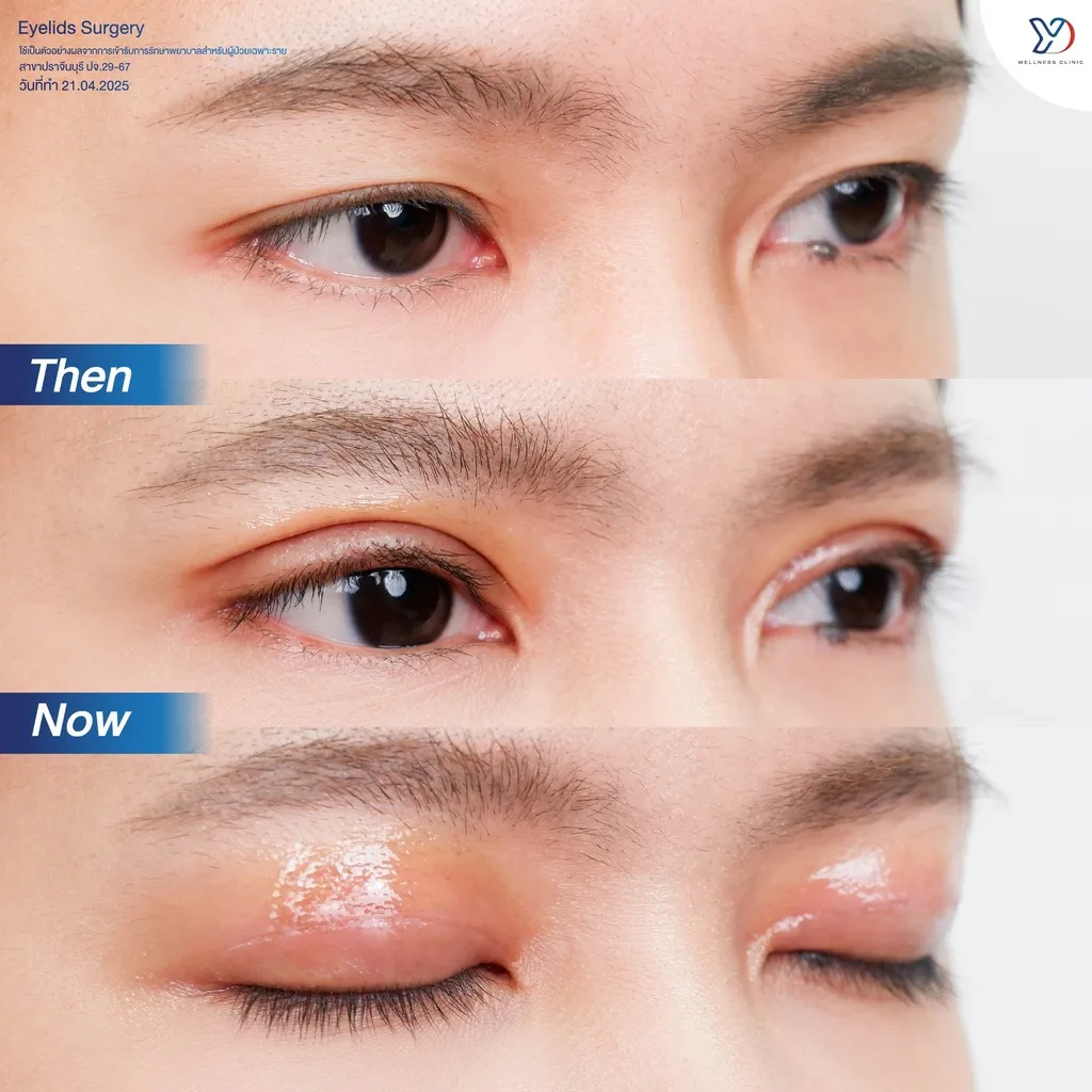 รีวิวตาสองชั้นยองโด-06