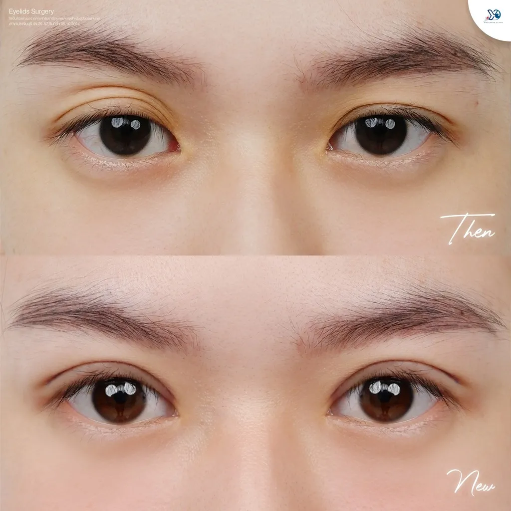 รีวิวตาสองชั้นยองโด-08