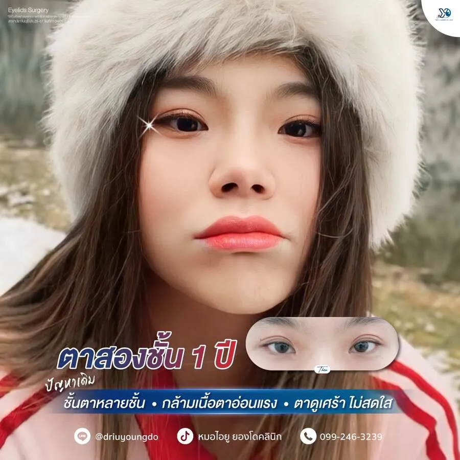 รีวิวตาสองชั้นยองโด-09
