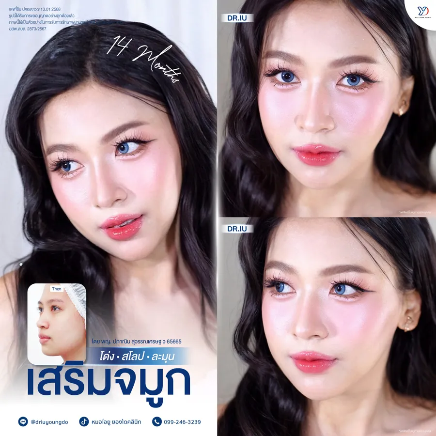 รีวิวเสริมจมูกยองโด-01