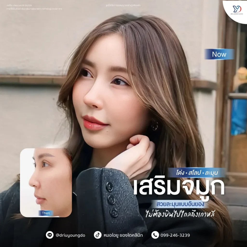 รีวิวเสริมจมูกยองโด-10