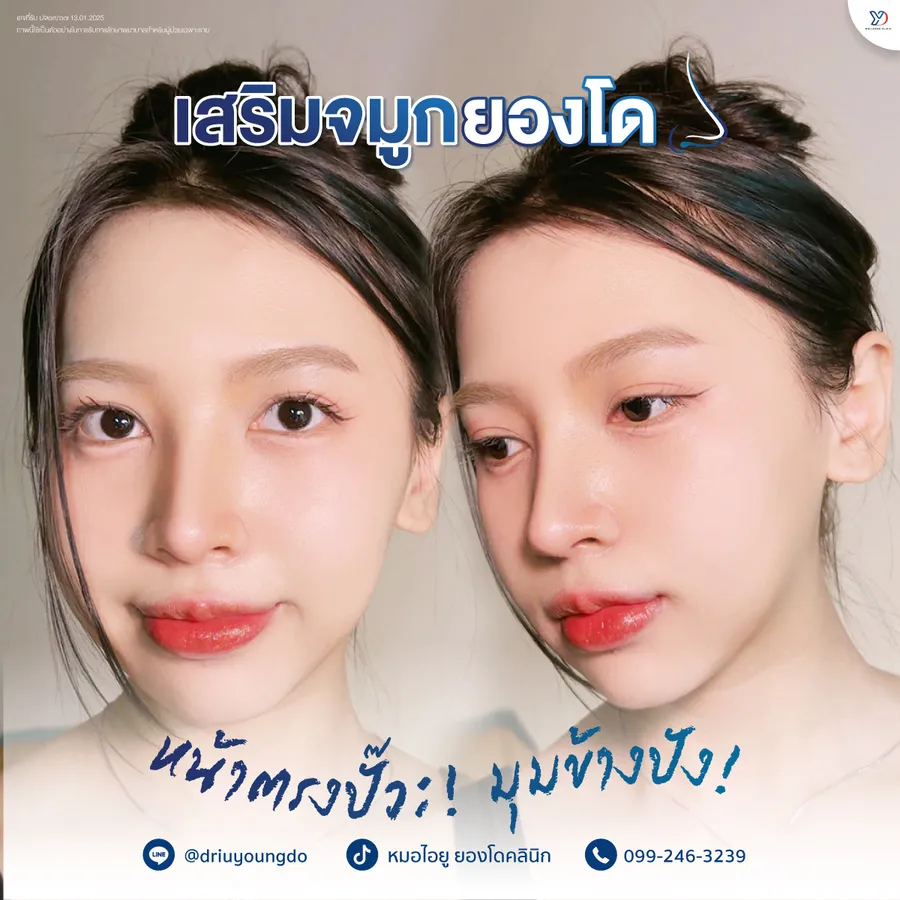 รีวิวเสริมจมูกยองโด-11
