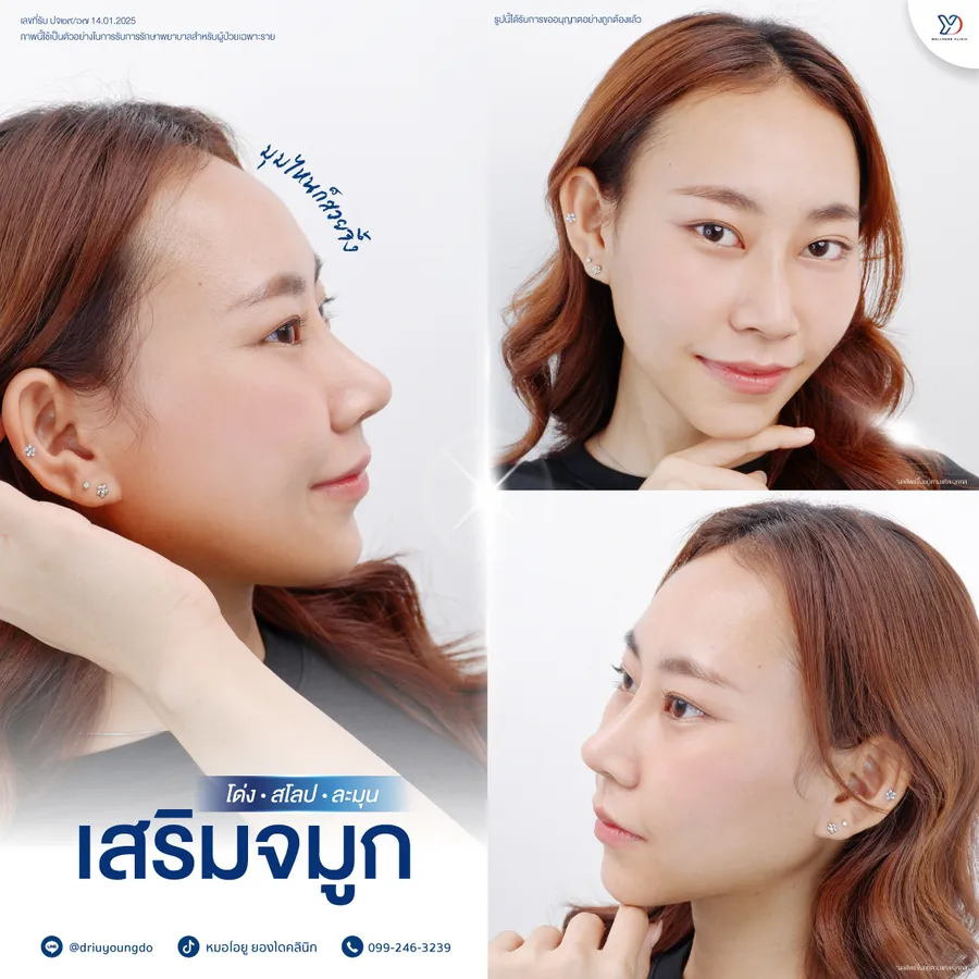 รีวิวเสริมจมูกยองโด-12