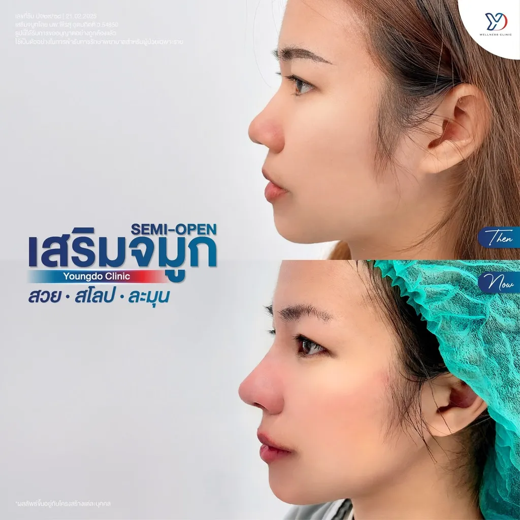 รีวิวเสริมจมูกยองโด-13