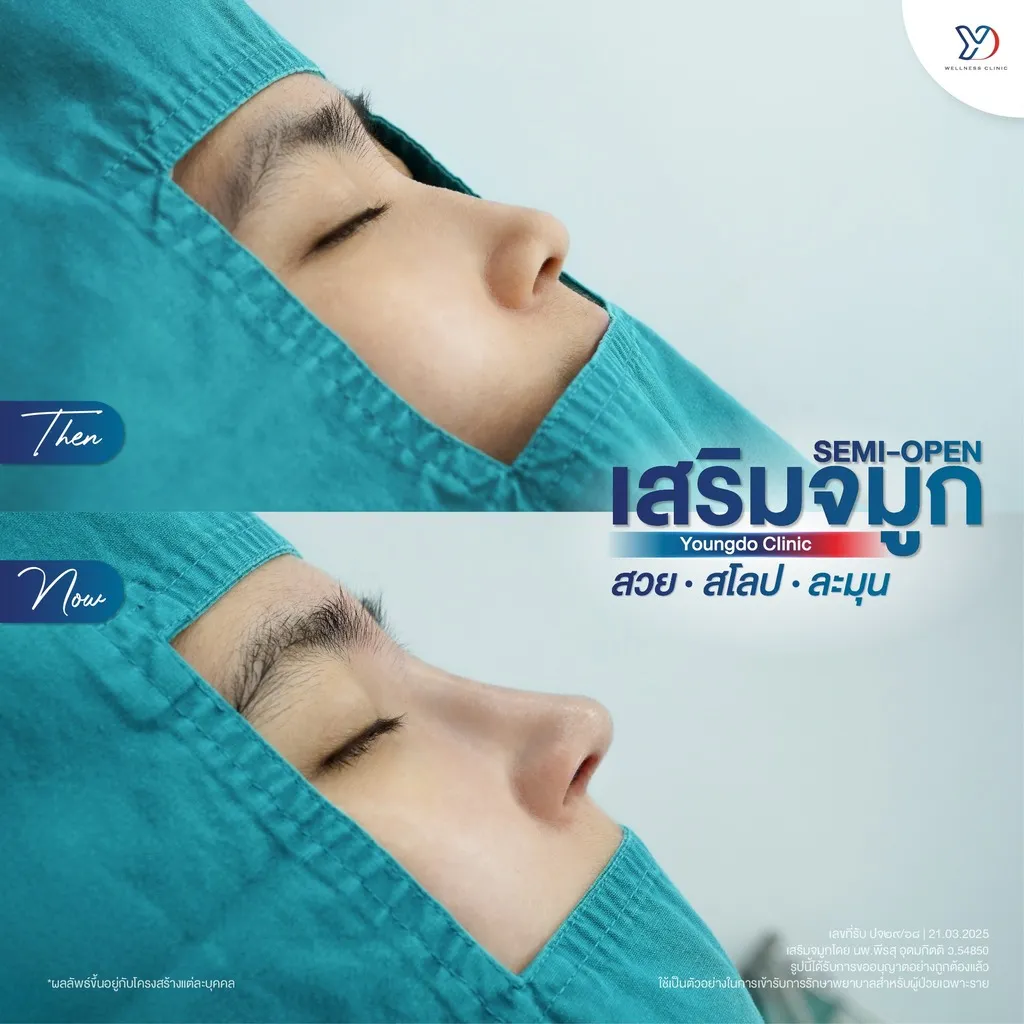 รีวิวเสริมจมูกยองโด-14