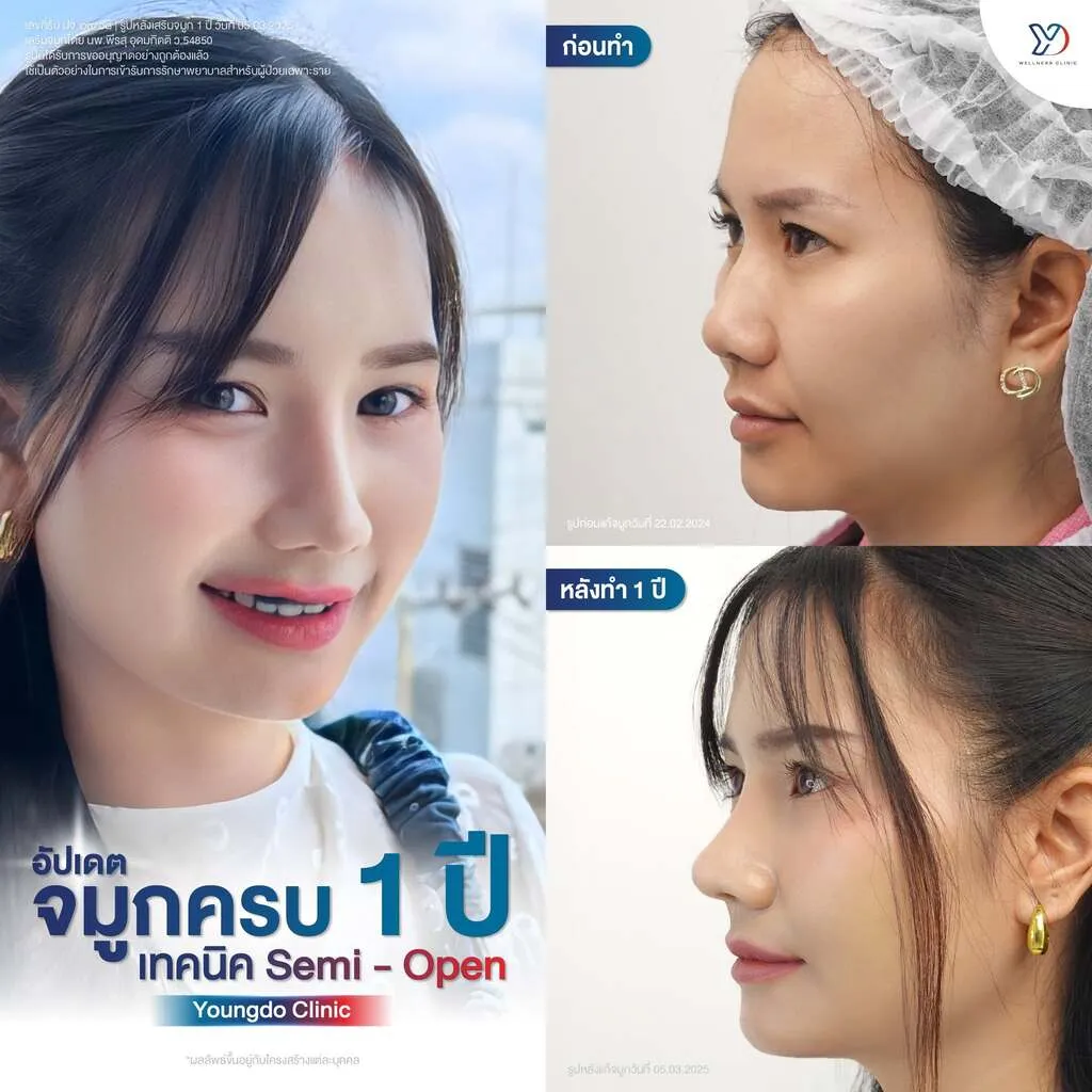 รีวิวเสริมจมูกยองโด-15