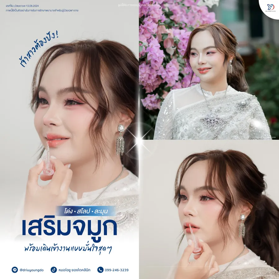 รีวิวเสริมจมูกยองโด-18