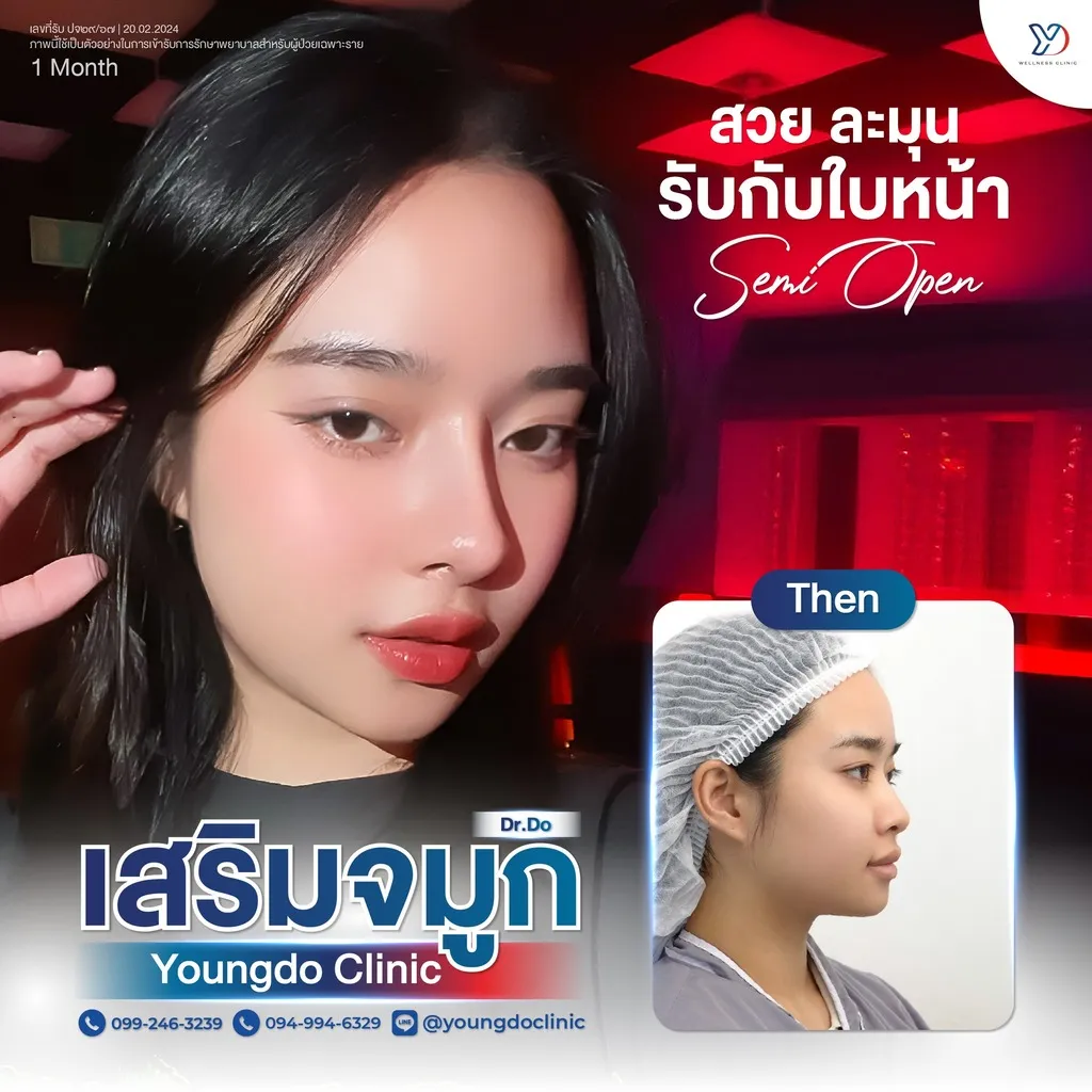 รีวิวเสริมจมูกยองโด-19
