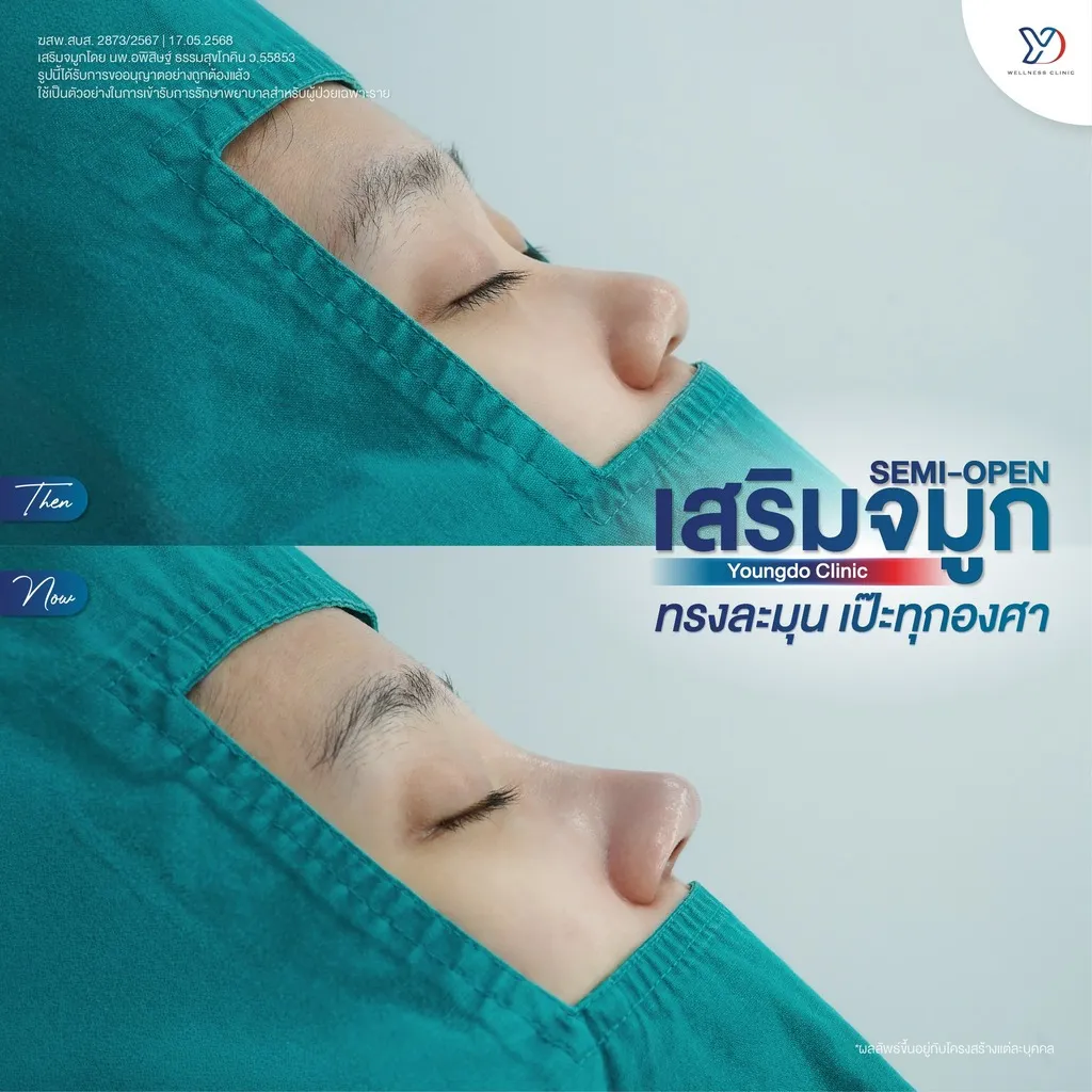 รีวิวเสริมจมูกยองโด-02