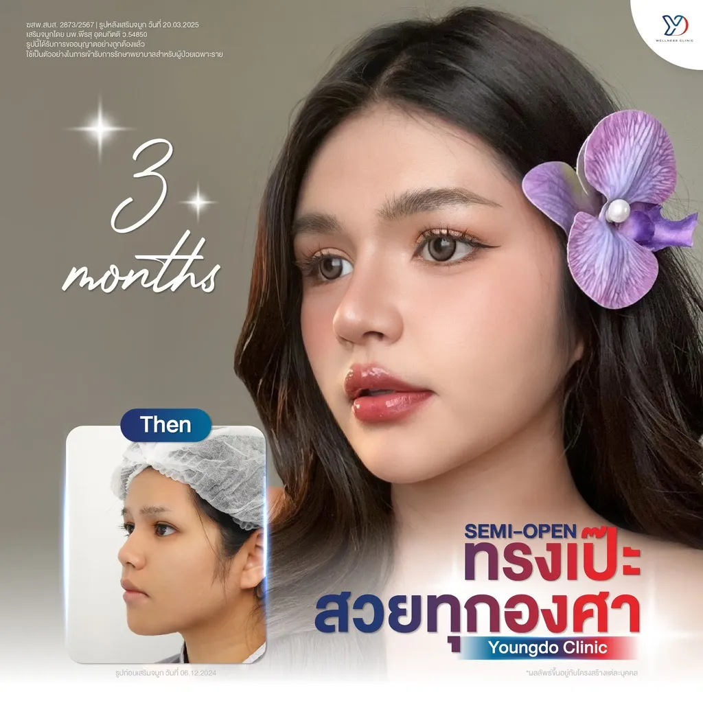 รีวิวเสริมจมูกยองโด-20