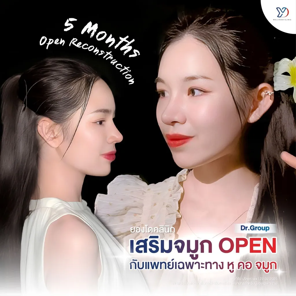 รีวิวเสริมจมูกยองโด-21