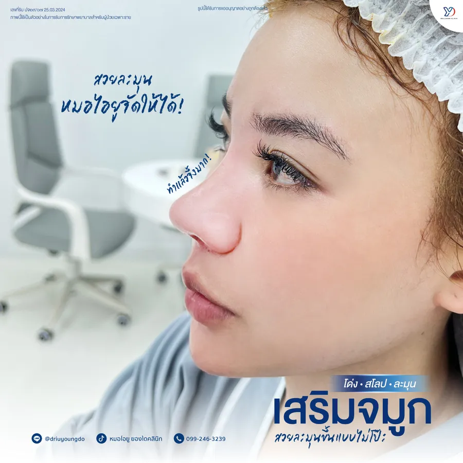 รีวิวเสริมจมูกยองโด-22