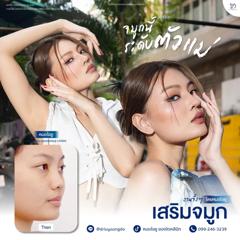 รีวิวเสริมจมูกยองโด-23