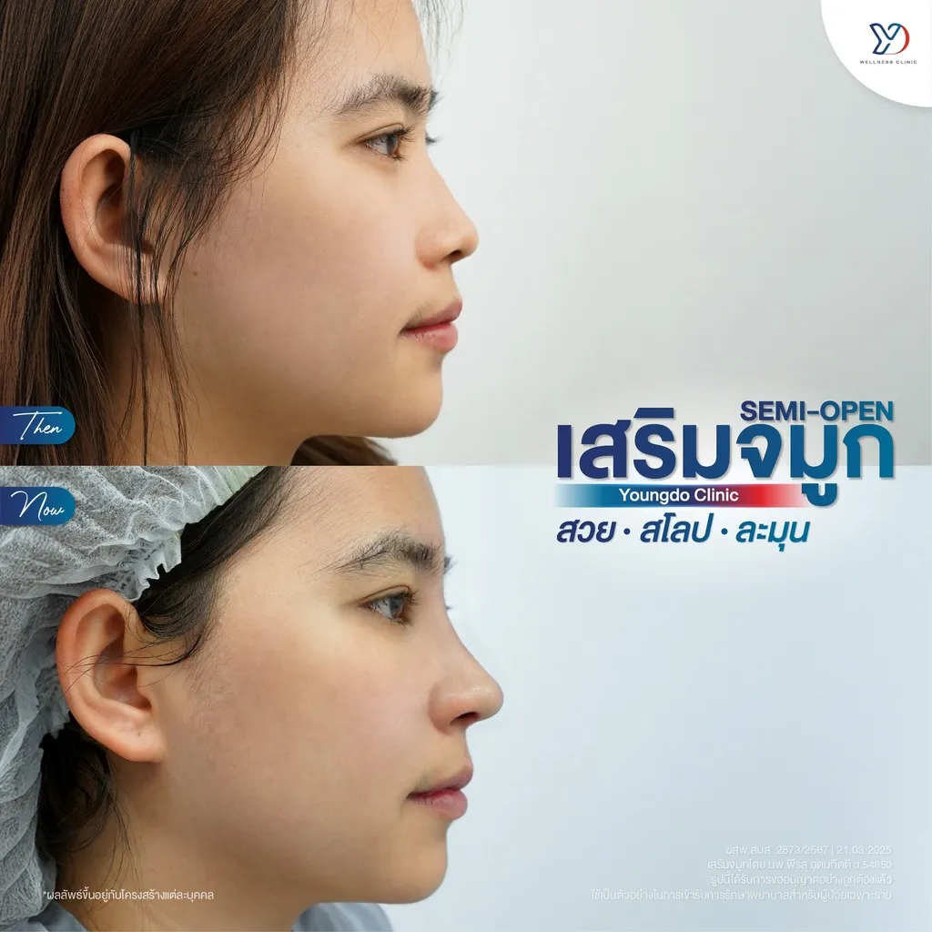 รีวิวเสริมจมูกยองโด-24