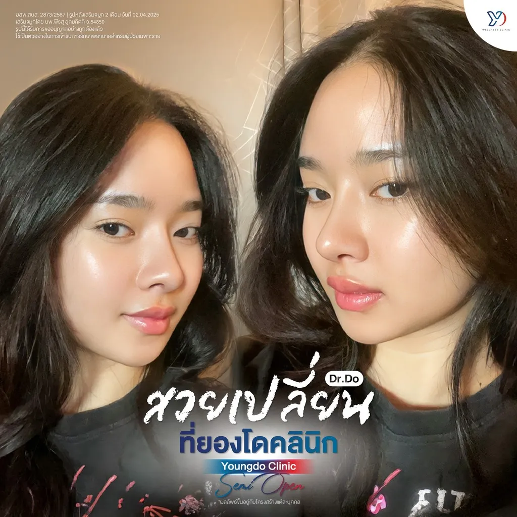 รีวิวเสริมจมูกยองโด-25