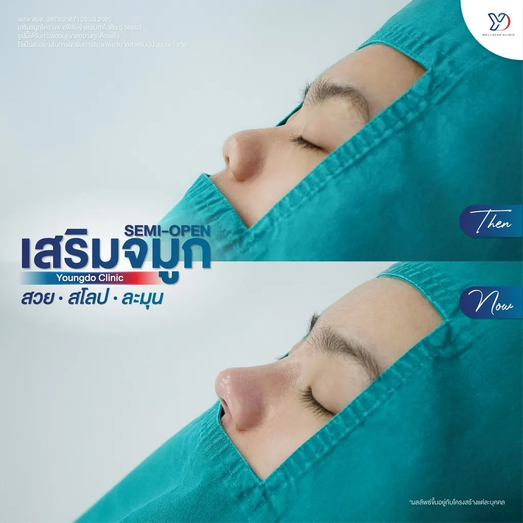 รีวิวเสริมจมูกยองโด-26