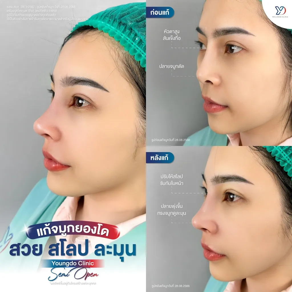 รีวิวเสริมจมูกยองโด-27