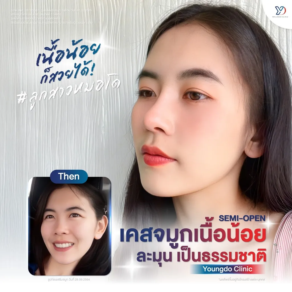 รีวิวเสริมจมูกยองโด-28