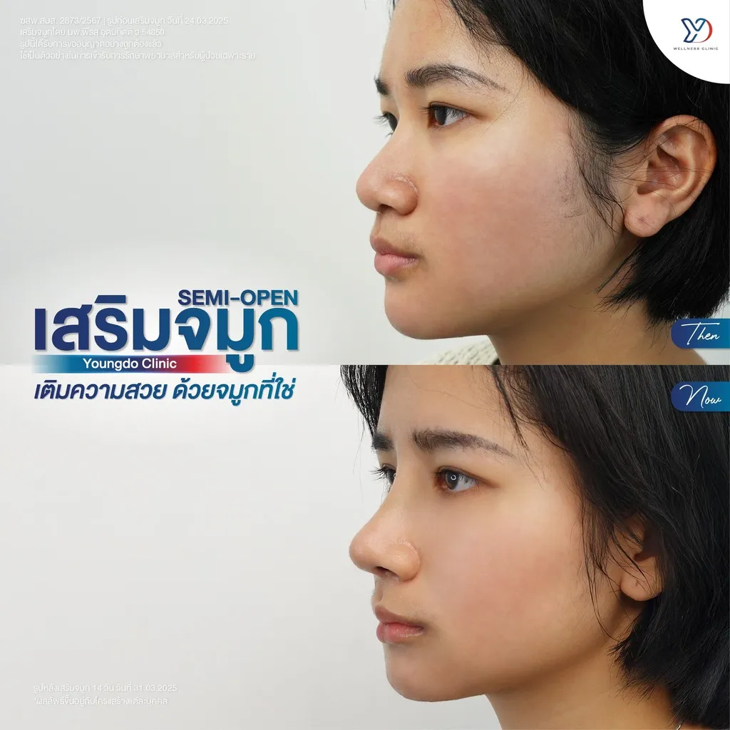 รีวิวเสริมจมูกยองโด-30