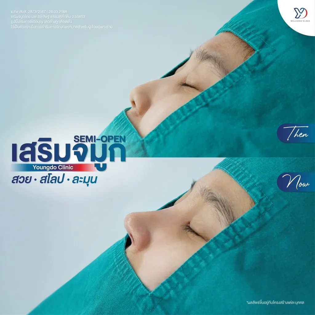 รีวิวเสริมจมูกยองโด-31