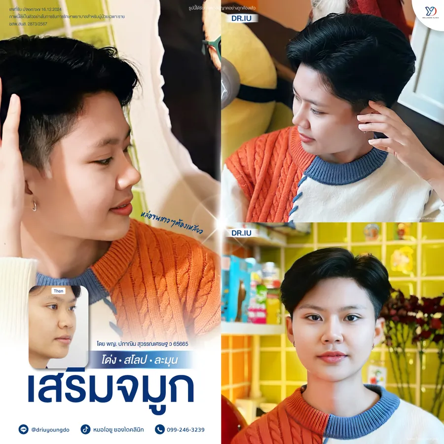 รีวิวเสริมจมูกยองโด-32