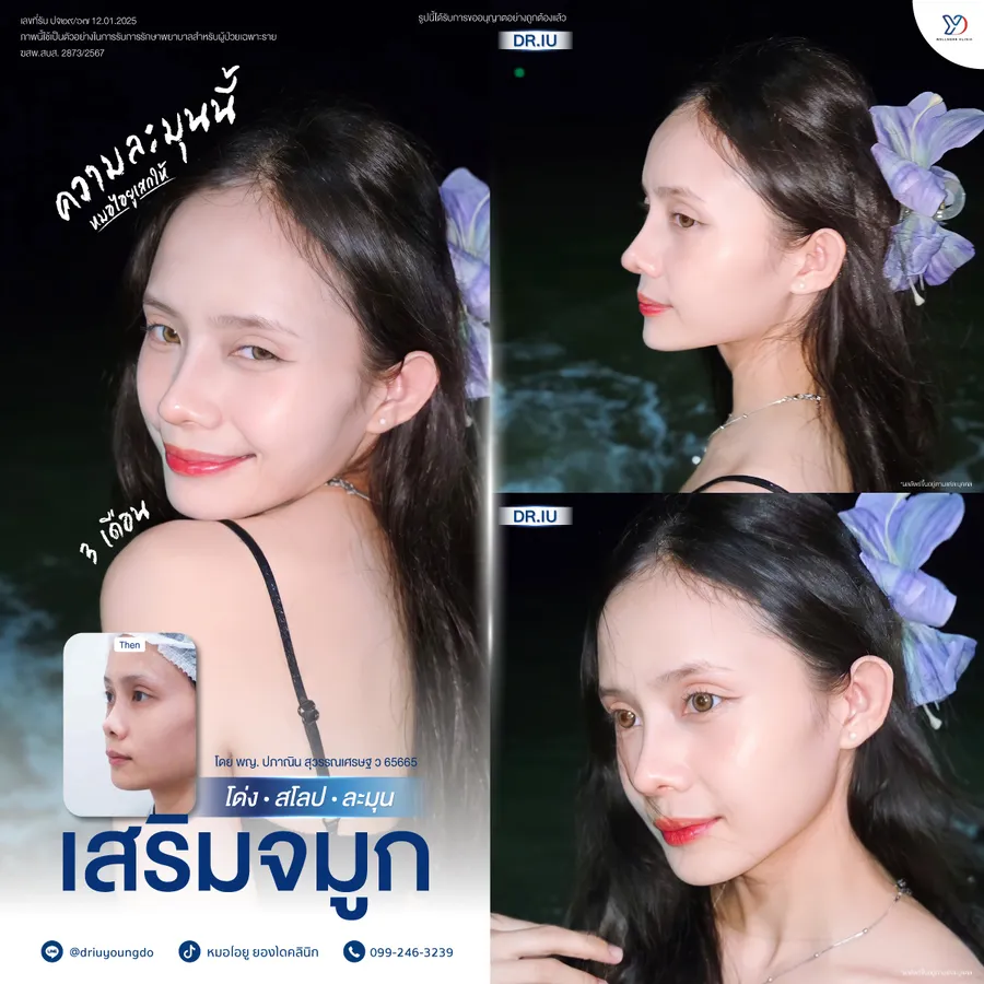 รีวิวเสริมจมูกยองโด-33