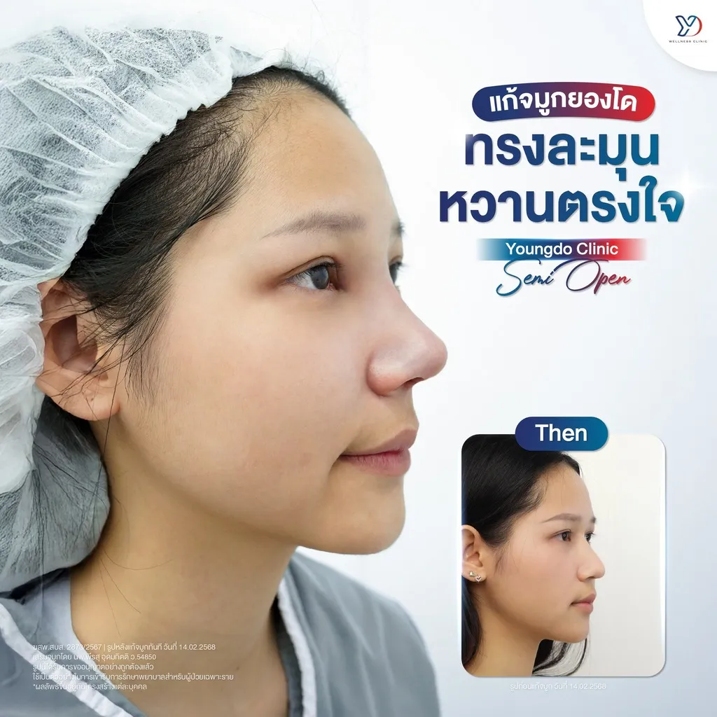 รีวิวเสริมจมูกยองโด-34