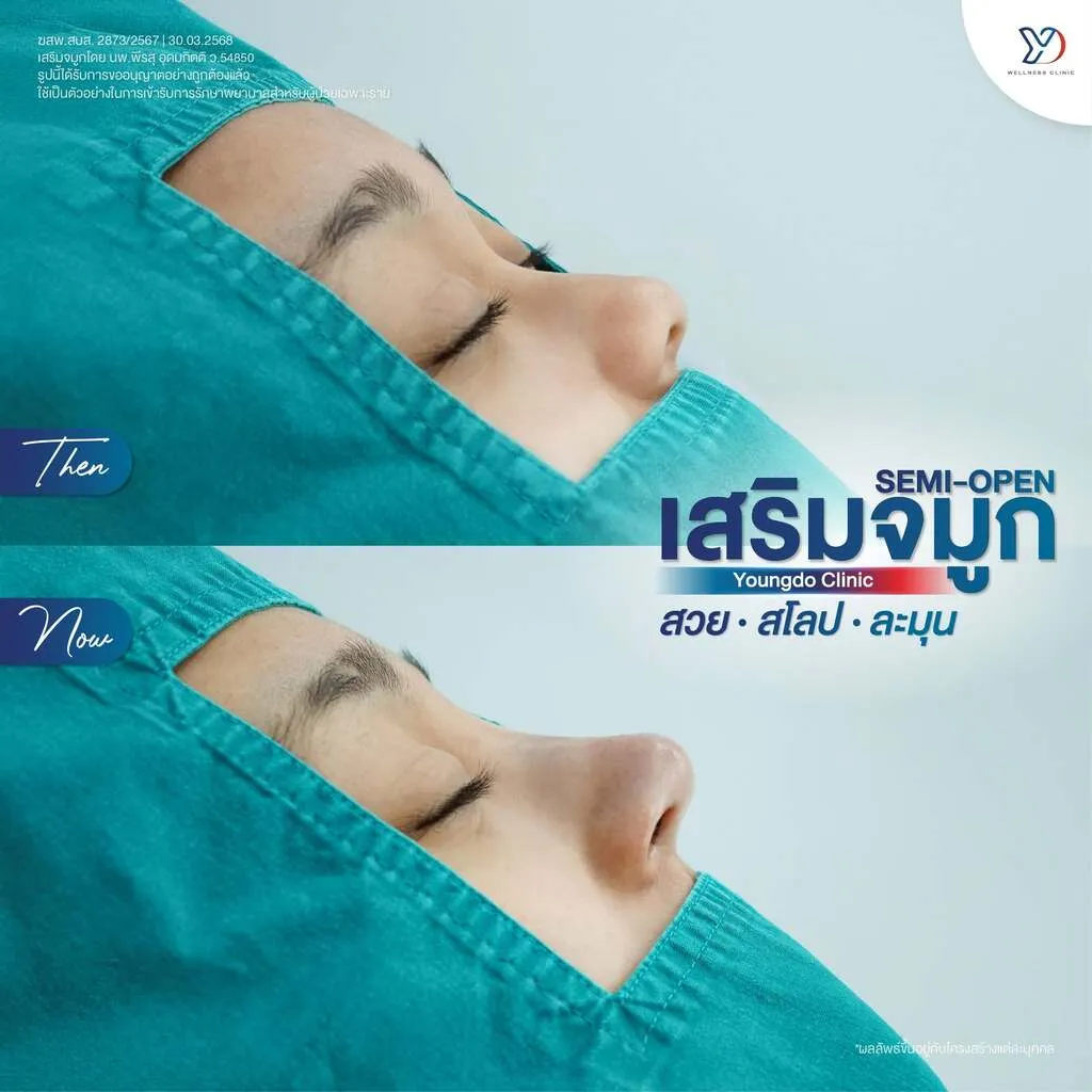 รีวิวเสริมจมูกยองโด-35
