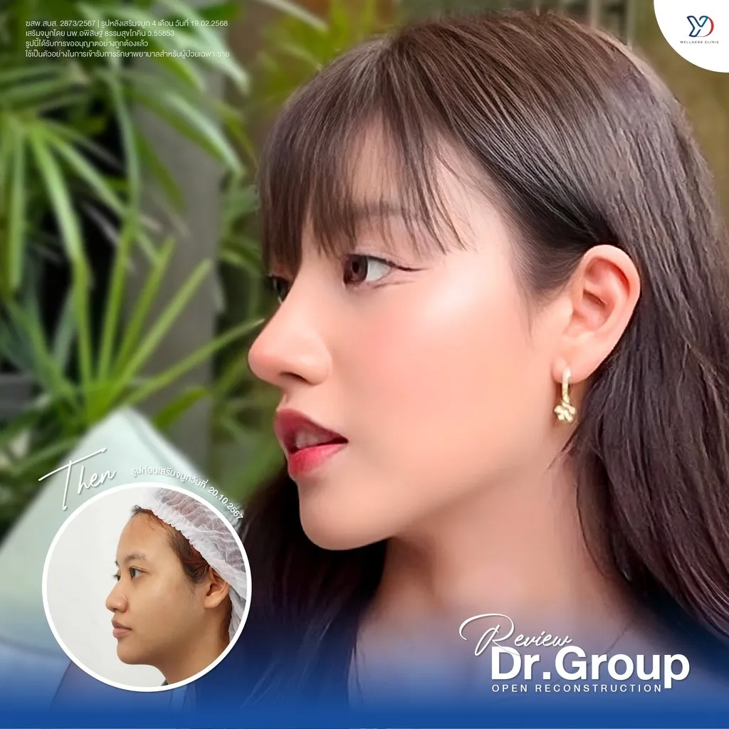 รีวิวเสริมจมูกยองโด-37