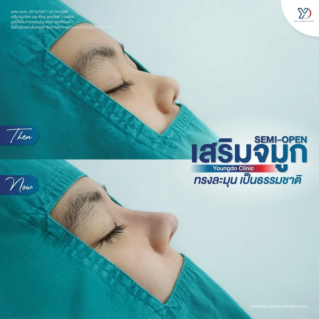 รีวิวเสริมจมูกยองโด-38