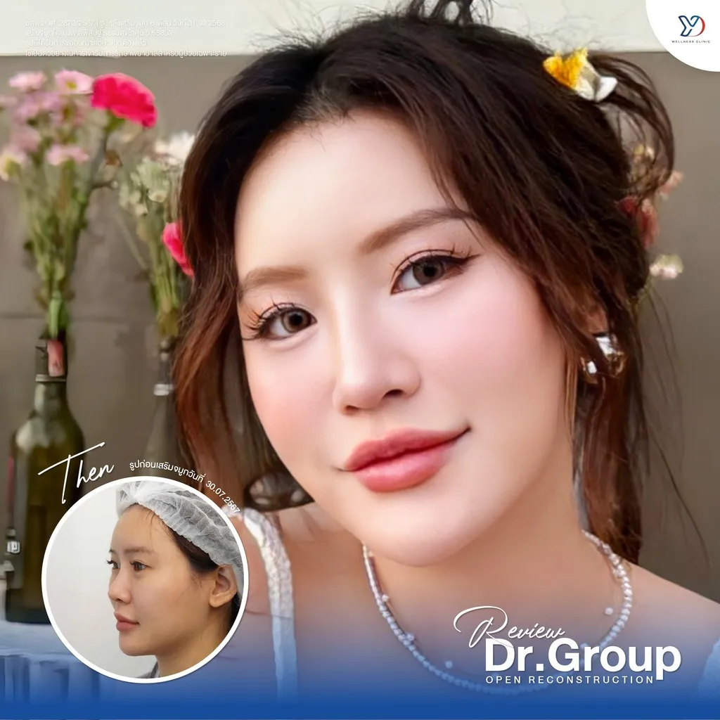 รีวิวเสริมจมูกยองโด-39