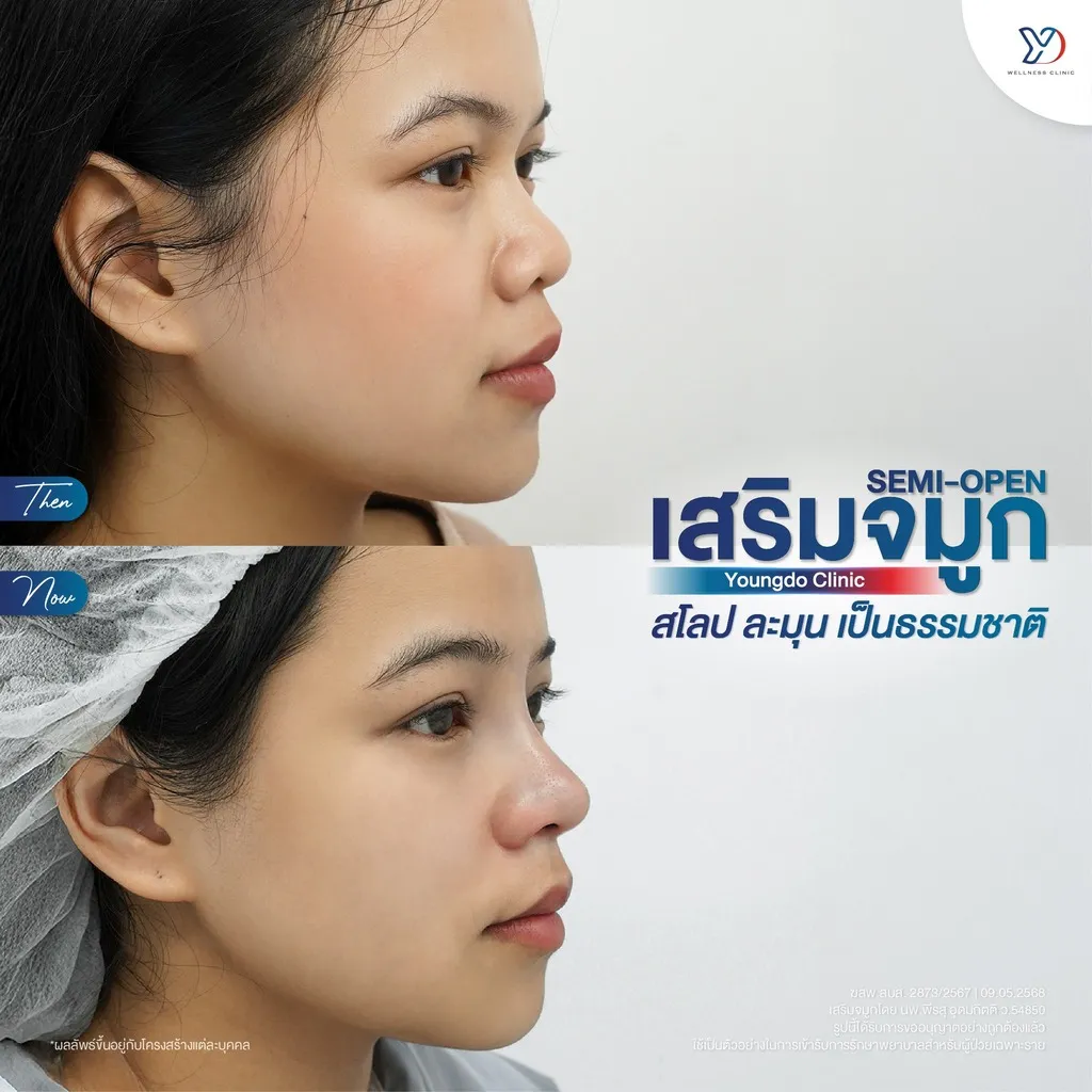 รีวิวเสริมจมูกยองโด-04