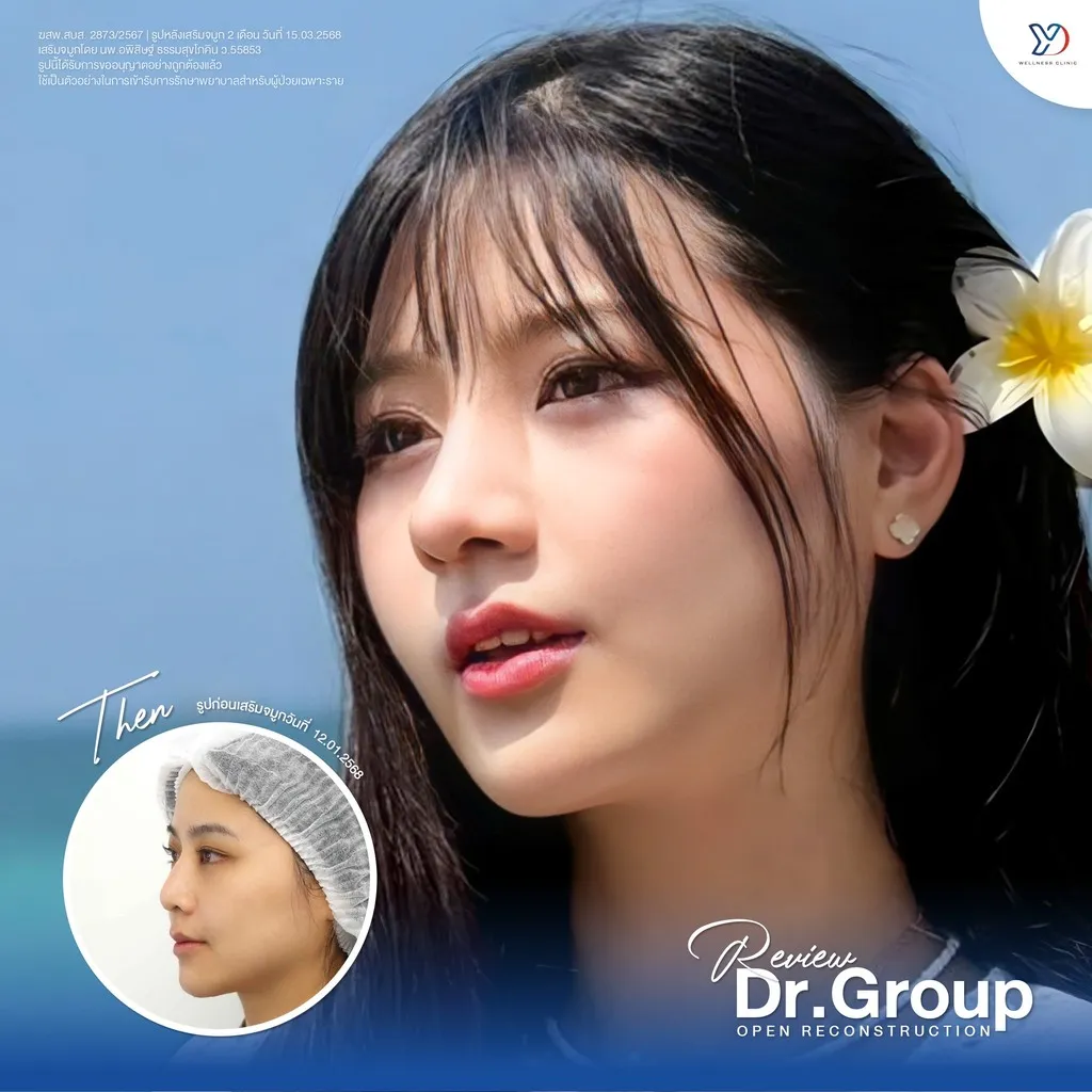 รีวิวเสริมจมูกยองโด-40