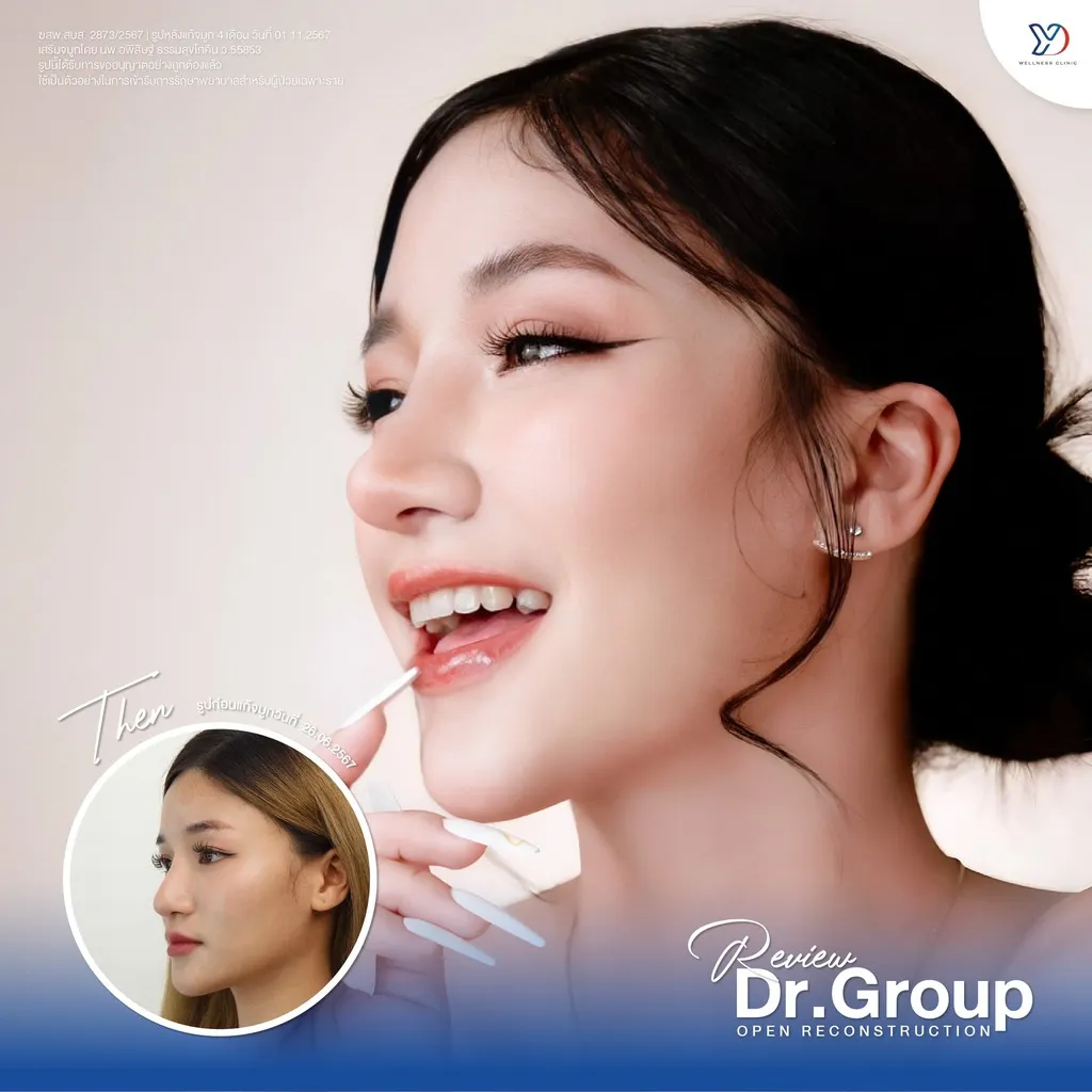 รีวิวเสริมจมูกยองโด-41