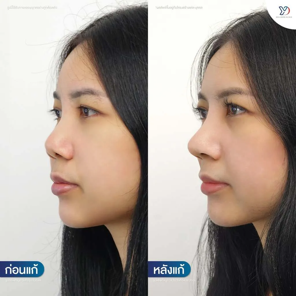 รีวิวเสริมจมูกยองโด-42