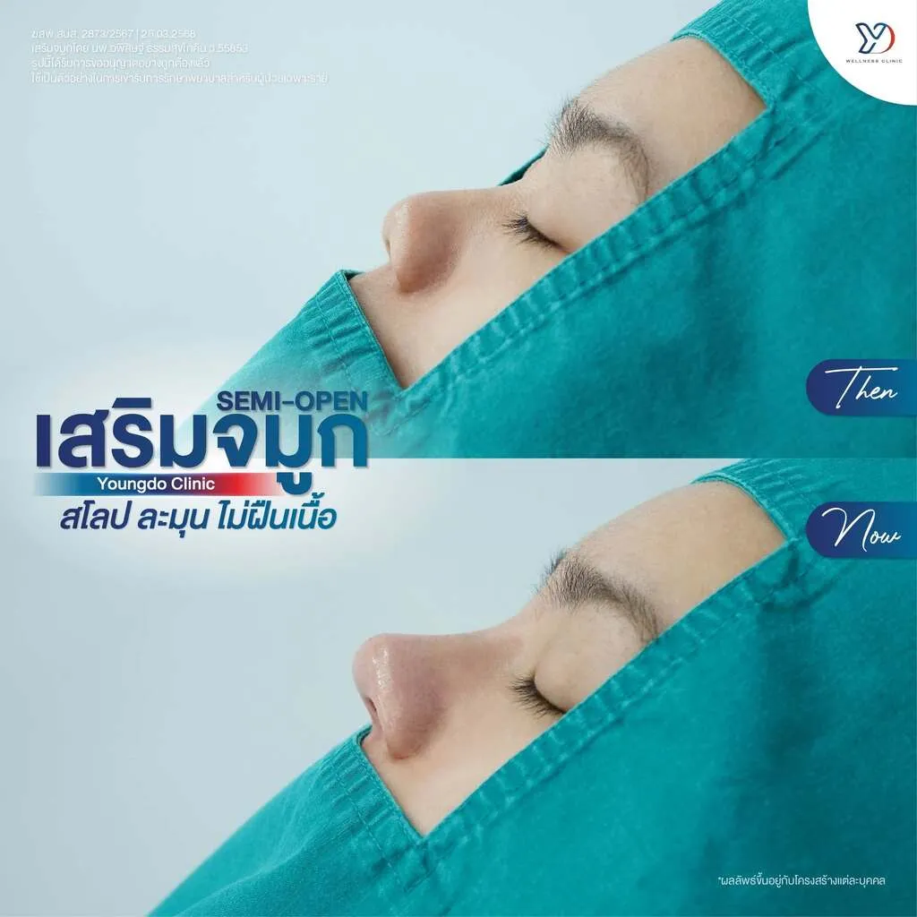 รีวิวเสริมจมูกยองโด-44