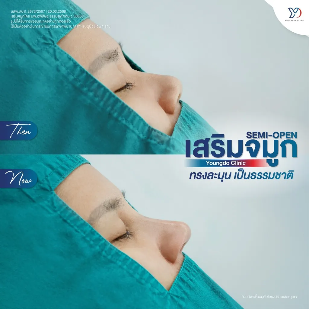 รีวิวเสริมจมูกยองโด-46