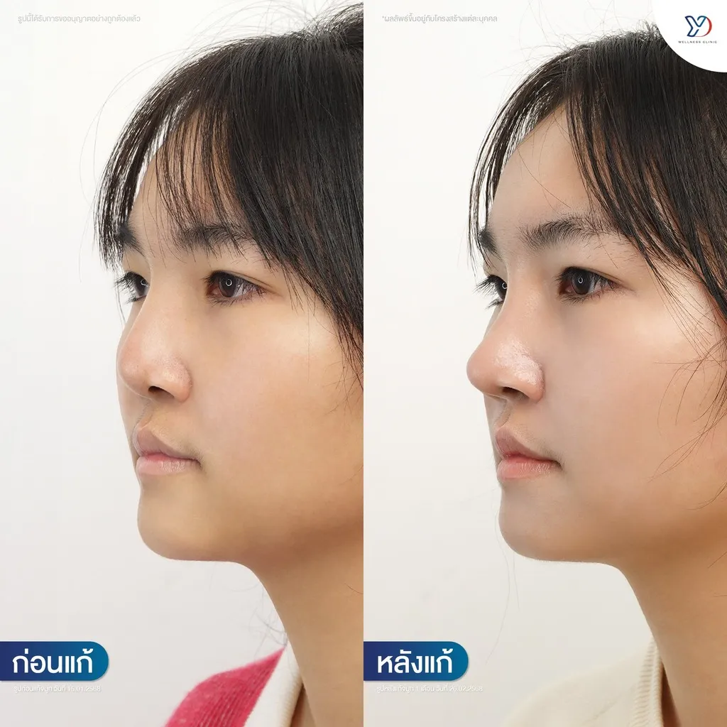 รีวิวเสริมจมูกยองโด-47