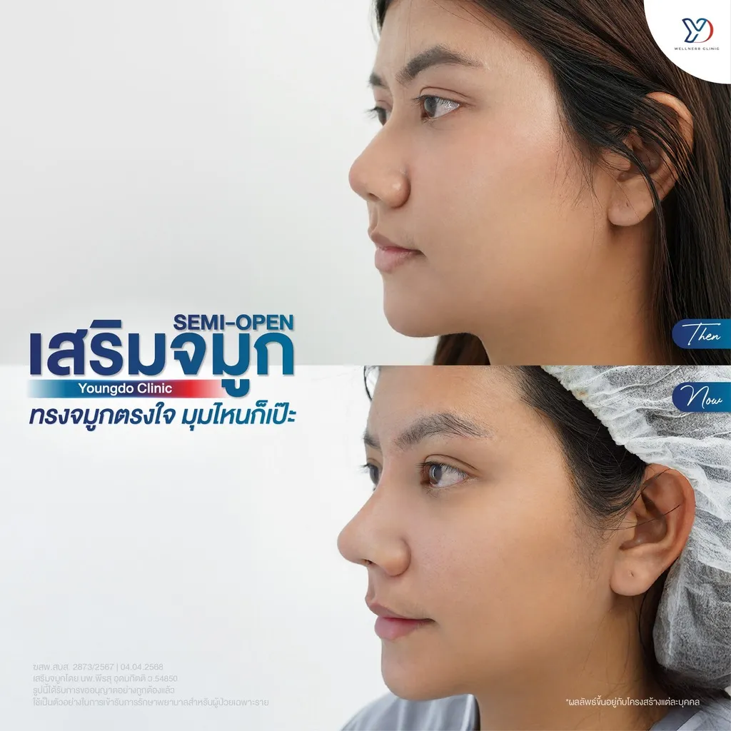 รีวิวเสริมจมูกยองโด-48