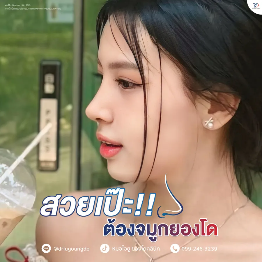 รีวิวเสริมจมูกยองโด-05