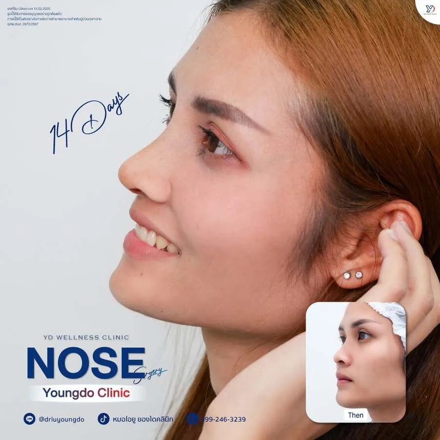 รีวิวเสริมจมูกยองโด-50
