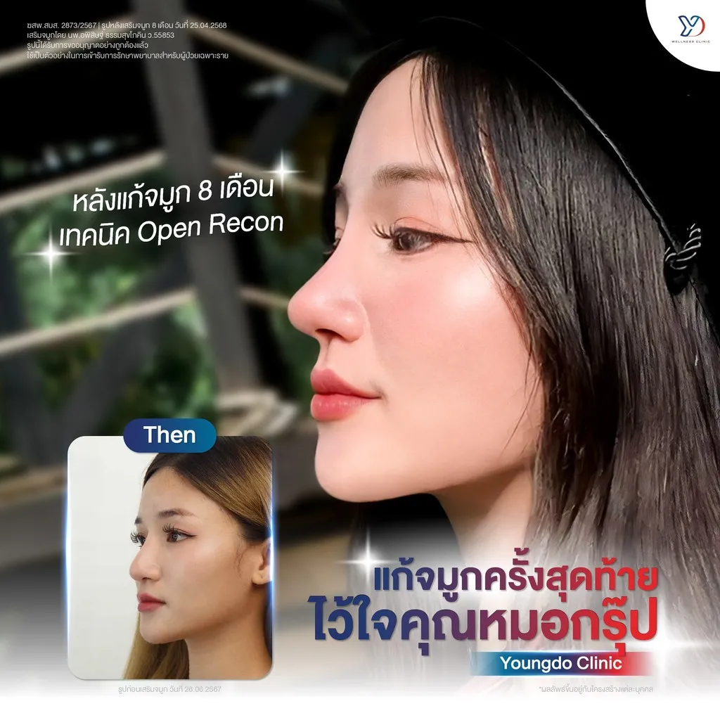 รีวิวเสริมจมูกยองโด-51