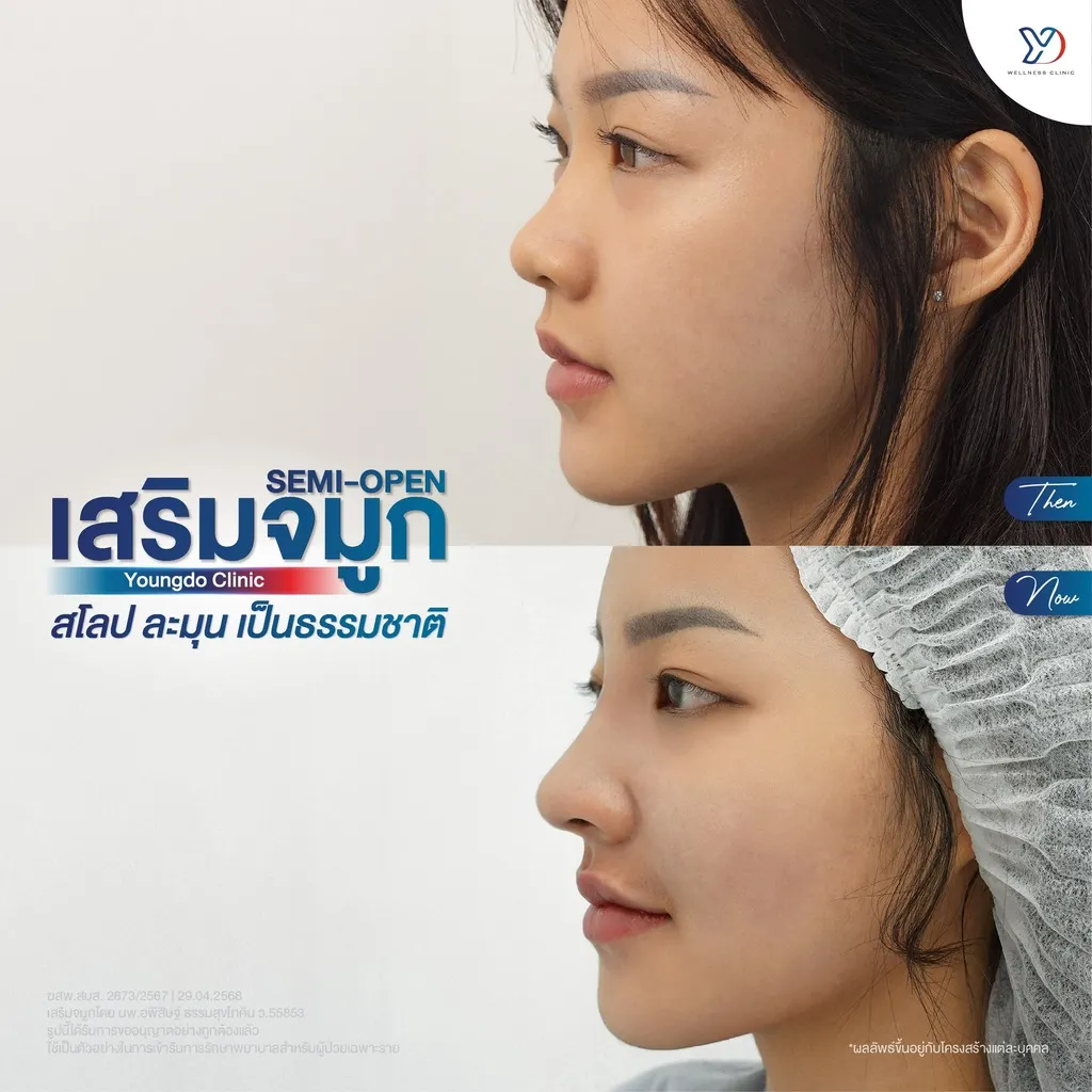 รีวิวเสริมจมูกยองโด-53