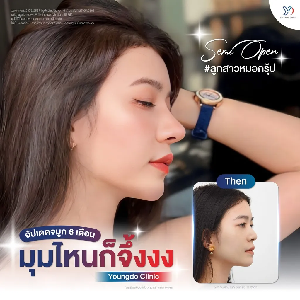 รีวิวเสริมจมูกยองโด-54