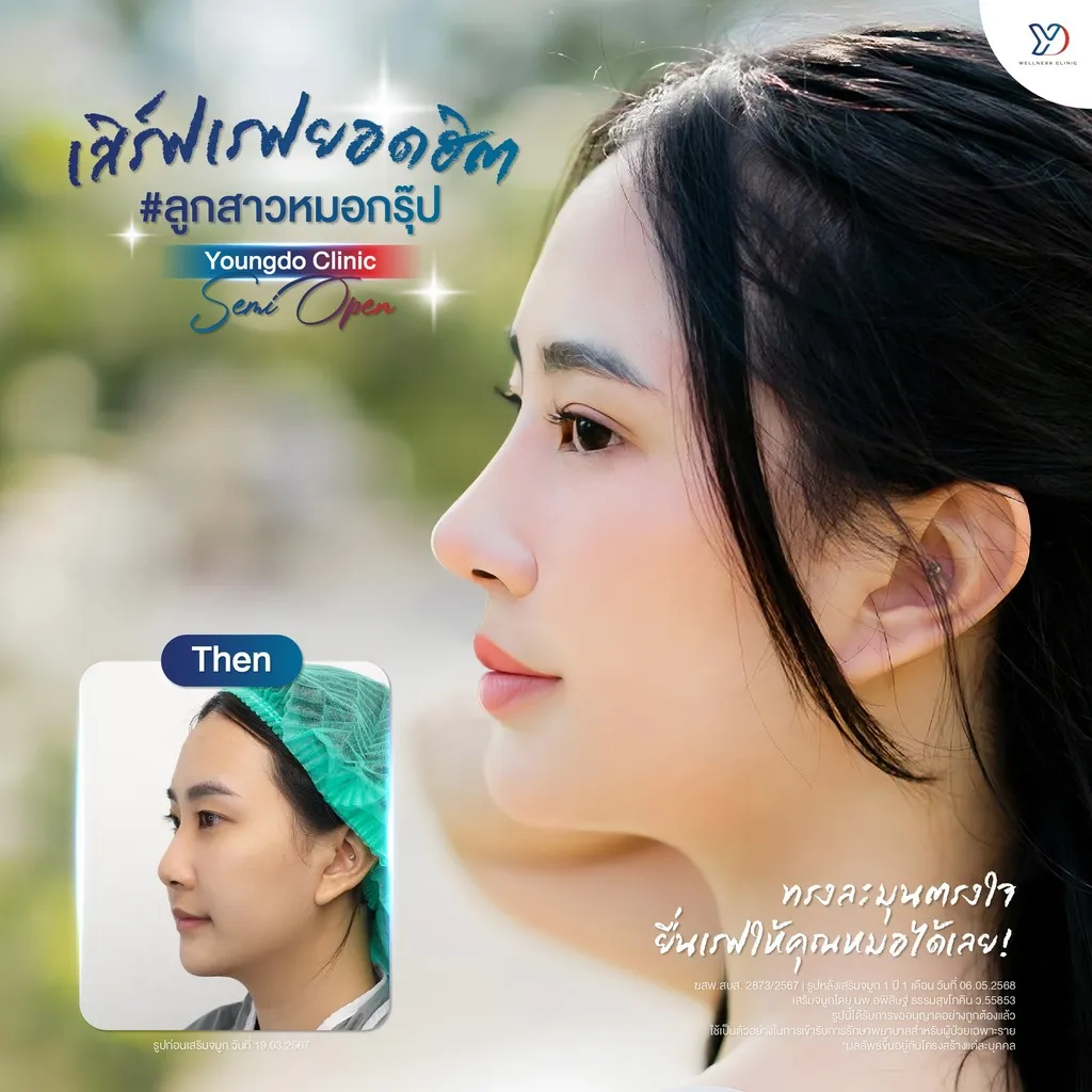 รีวิวเสริมจมูกยองโด-55