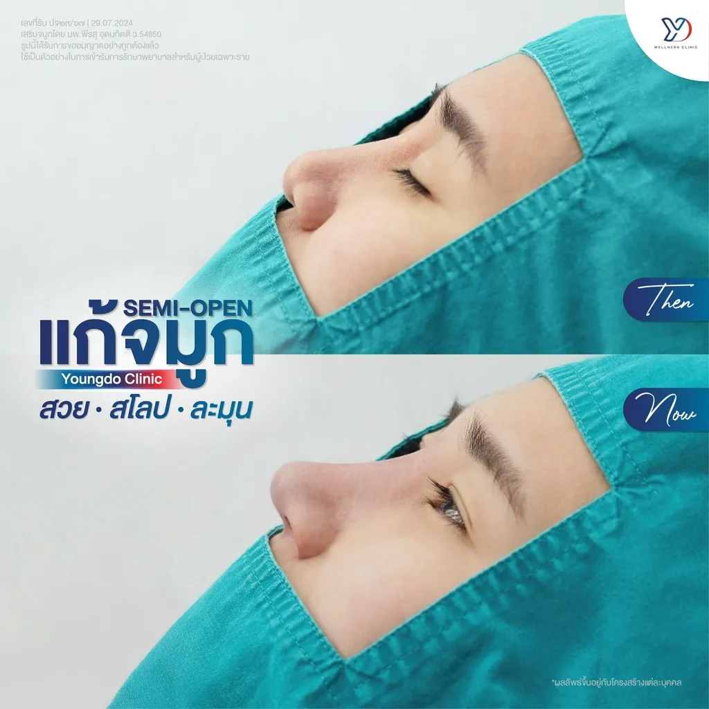 รีวิวเสริมจมูกยองโด-06