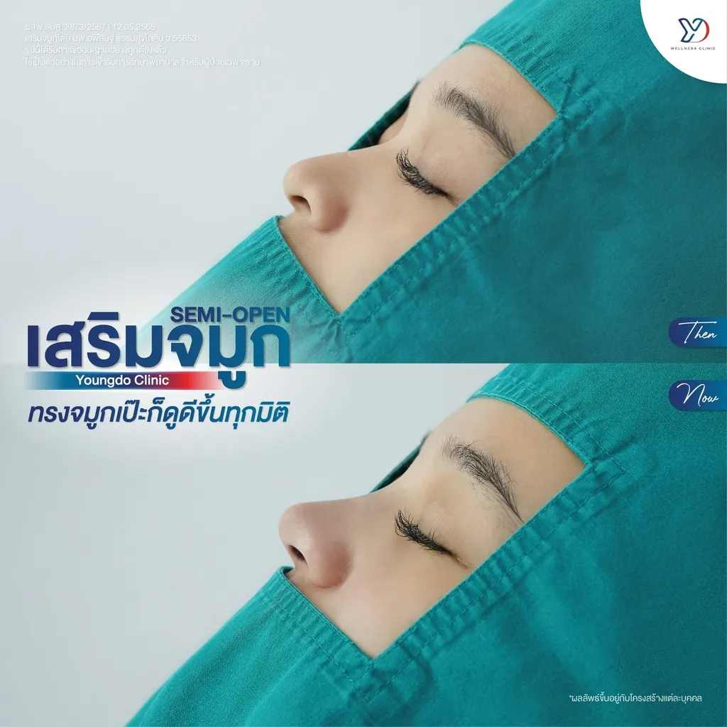 รีวิวเสริมจมูกยองโด-07