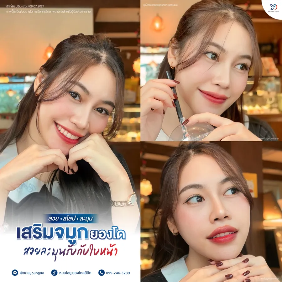รีวิวเสริมจมูกยองโด-08