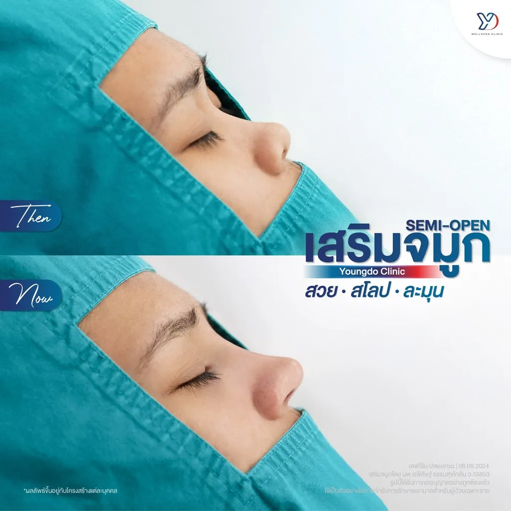 รีวิวเสริมจมูกยองโด-09